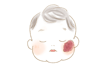 顔の赤み いちご状血管腫