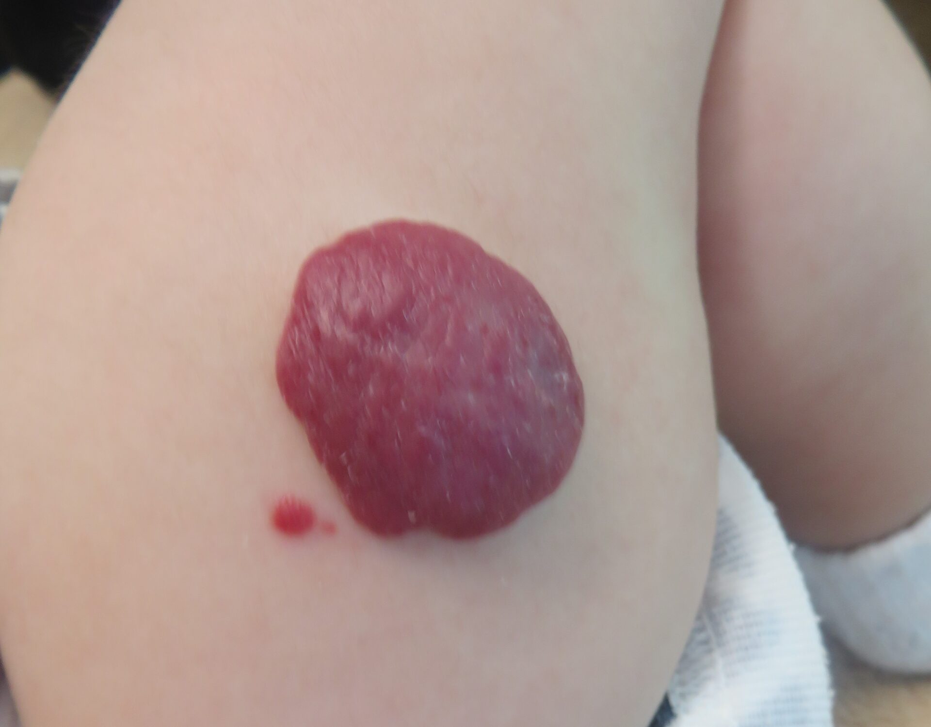 いちご状血管腫 | 赤ちゃん・子供のあざ治療なら｜最新レーザー治療  