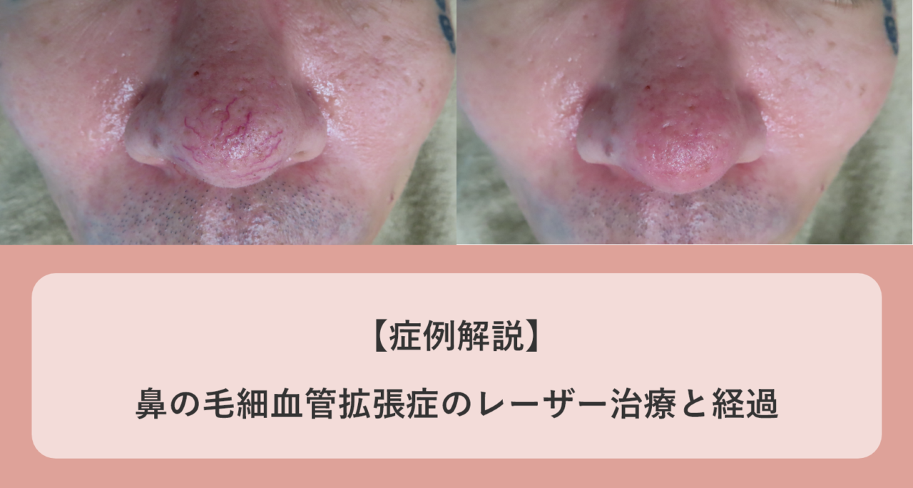 血管拡張にはどのような症状が関係しますか?