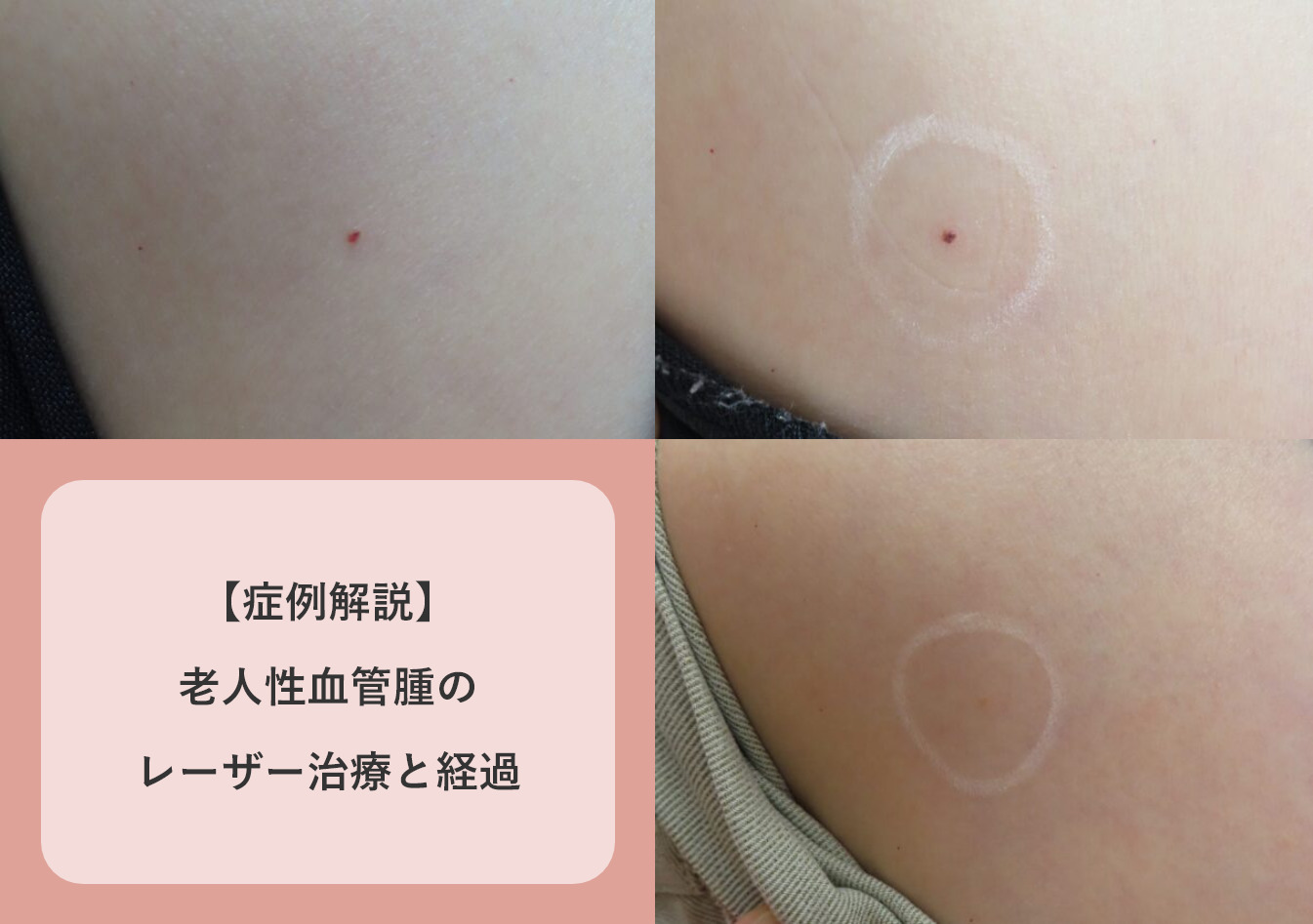 症例解説】老人性血管腫のレーザー治療と経過 | 赤ちゃん・子供のあざ