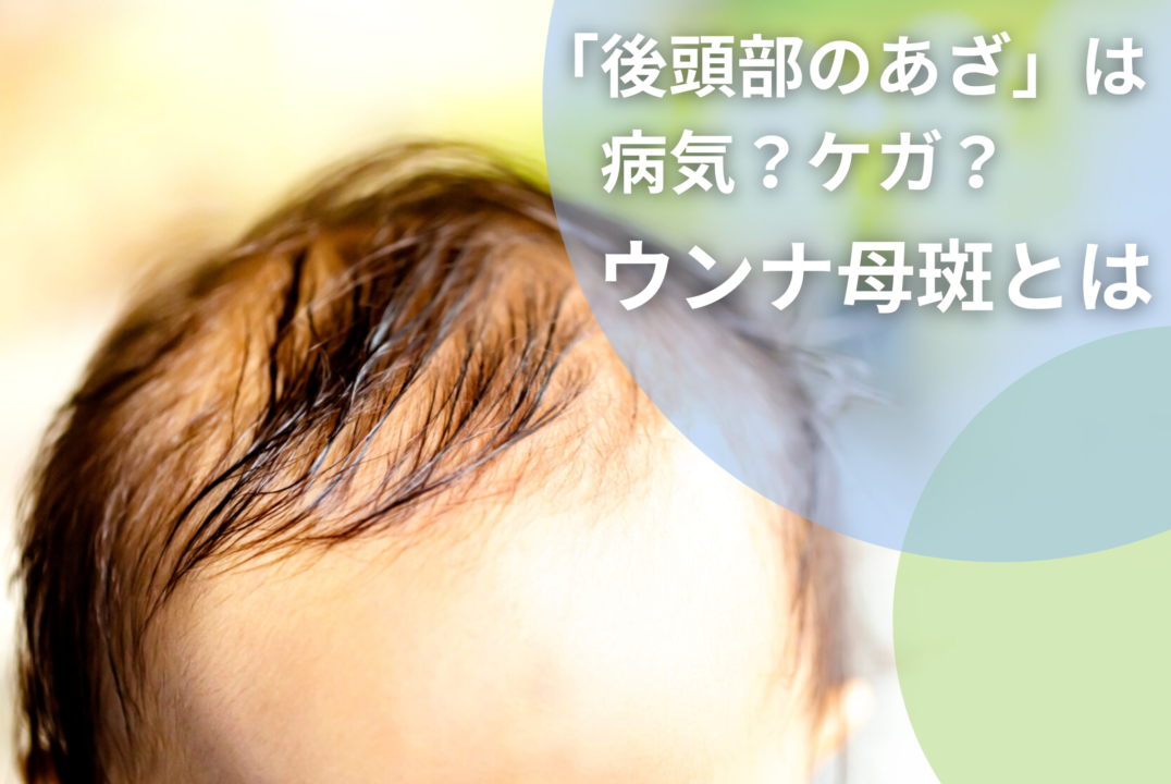 赤ちゃんの後頭部にあざを発見！病気？ケガ？そんな不安を解消します 