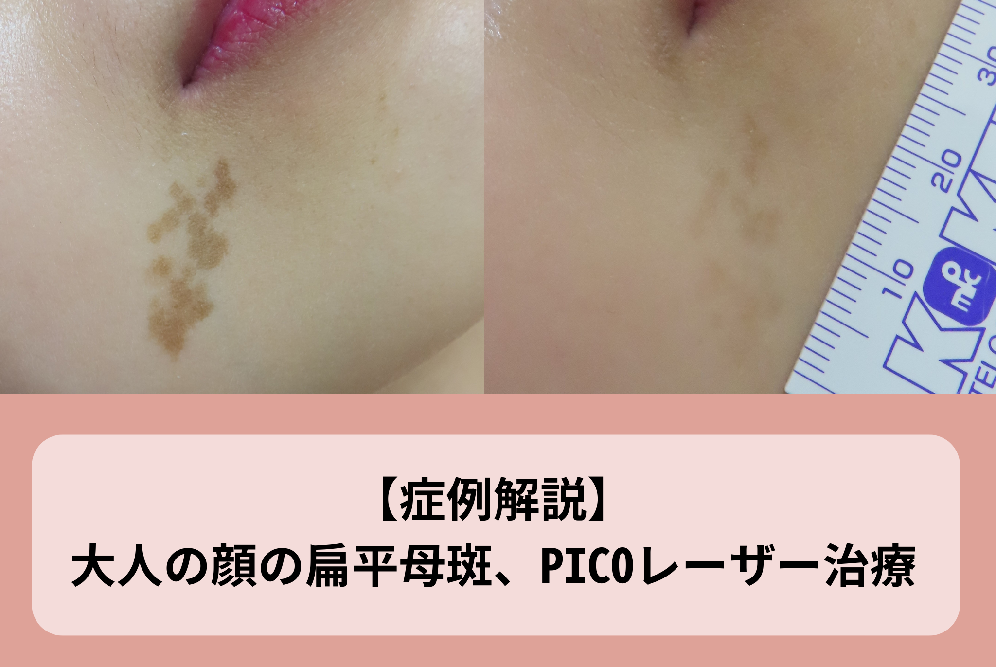 症例解説】大人の顔の扁平母斑、PICOレーザー治療 | 赤ちゃん・子供の
