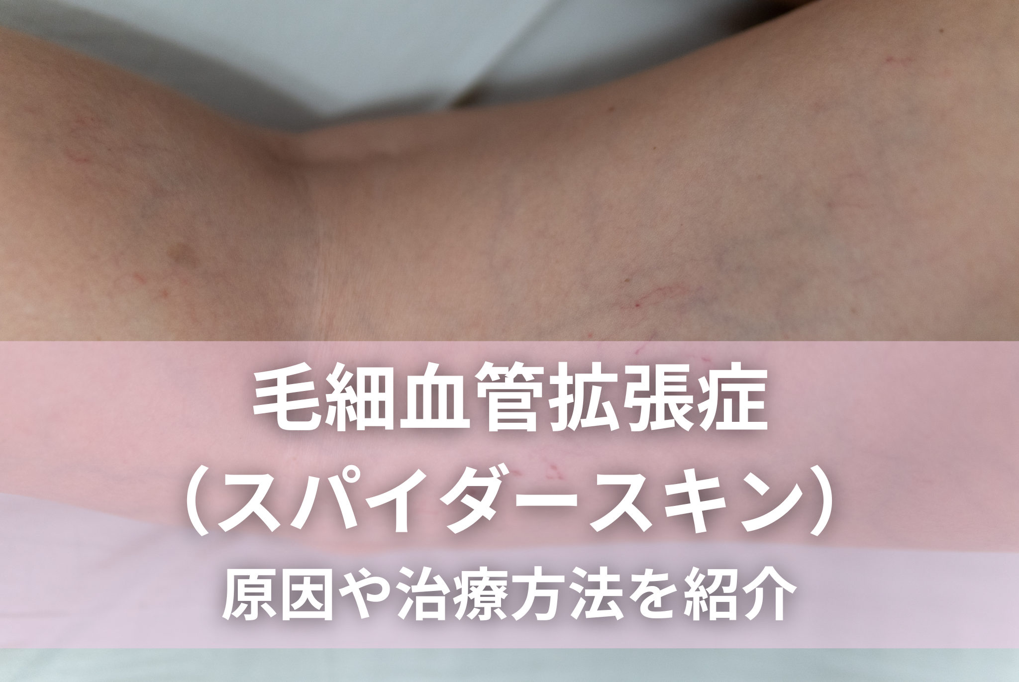 血管 細い 人