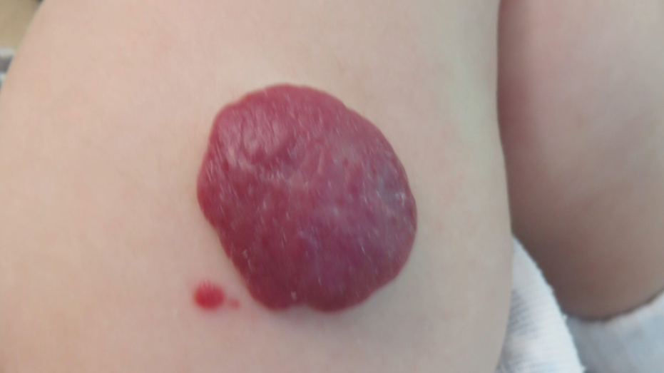 いちご状血管腫